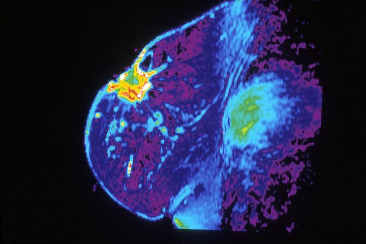 New machine learning method could spare some women from unnecessary breast surgery
